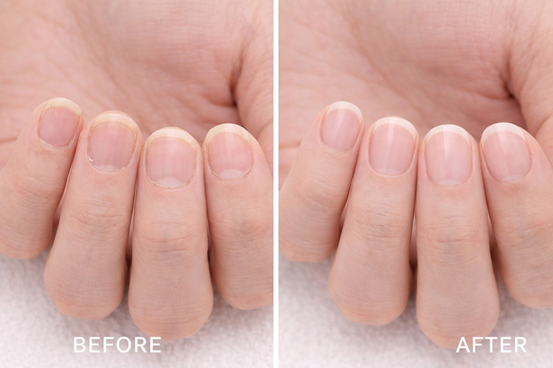 ハンドケア Before After